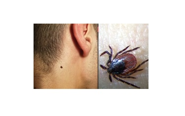 Photo d'une tique et d'une personne piquée par une tique