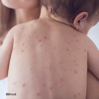 Photo du dos d'un bébé ayant la rubéole