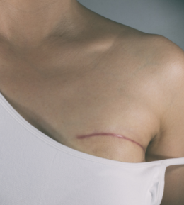Photo du torse d'une femme avec une cicatrice au niveau de la poitrine, illustrant la reconstruction mammaire